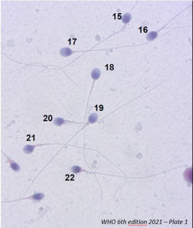 Spermocytogramme :  analyse morphologique des spermatozoïdes par la classification  de Kruger